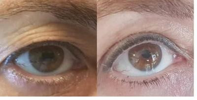 Avant/Après TeslaMed - Visage