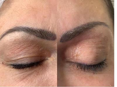 Avant/Après TeslaMed - Corps