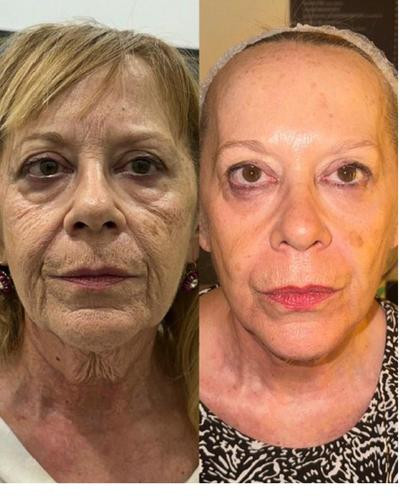 Avant/Après TeslaMed - Cuir chevelu